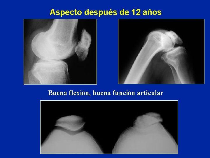 Aspecto después de 12 años Buena flexión, buena función articular Aspecto después de 12 años Buena flexión, buena función articular