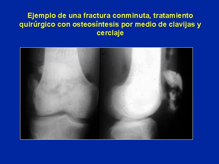 Ejemplo de una fractura conminuta, tratamiento quirúrgico con osteosíntesis por medio de clavijas y Ejemplo de una fractura conminuta, tratamiento quirúrgico con osteosíntesis por medio de clavijas y