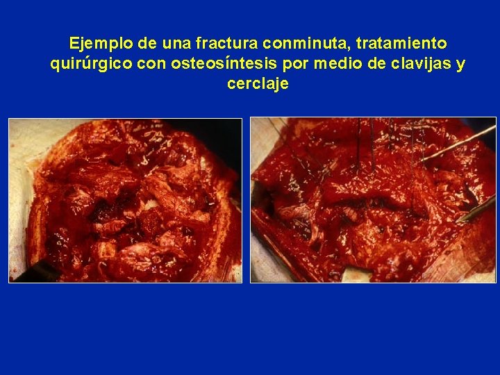 Ejemplo de una fractura conminuta, tratamiento quirúrgico con osteosíntesis por medio de clavijas y Ejemplo de una fractura conminuta, tratamiento quirúrgico con osteosíntesis por medio de clavijas y