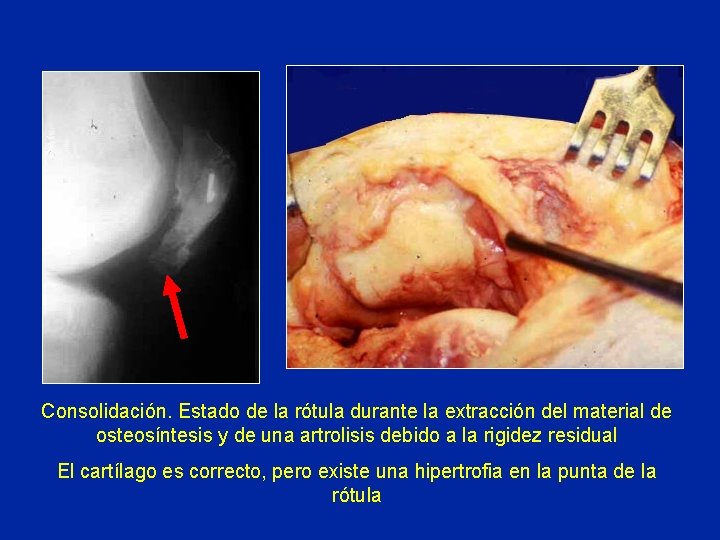 Consolidación. Estado de la rótula durante la extracción del material de osteosíntesis y de Consolidación. Estado de la rótula durante la extracción del material de osteosíntesis y de