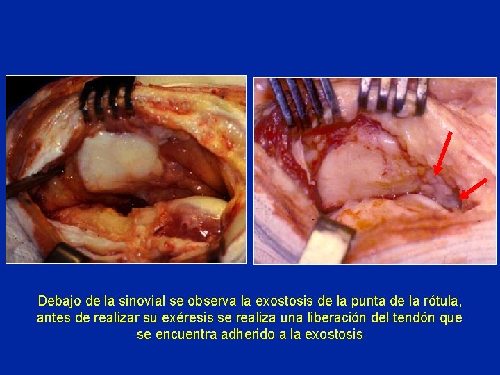 Debajo de la sinovial se observa la exostosis de la punta de la rótula, Debajo de la sinovial se observa la exostosis de la punta de la rótula,