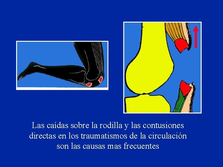 Las caídas sobre la rodilla y las contusiones directas en los traumatismos de la Las caídas sobre la rodilla y las contusiones directas en los traumatismos de la