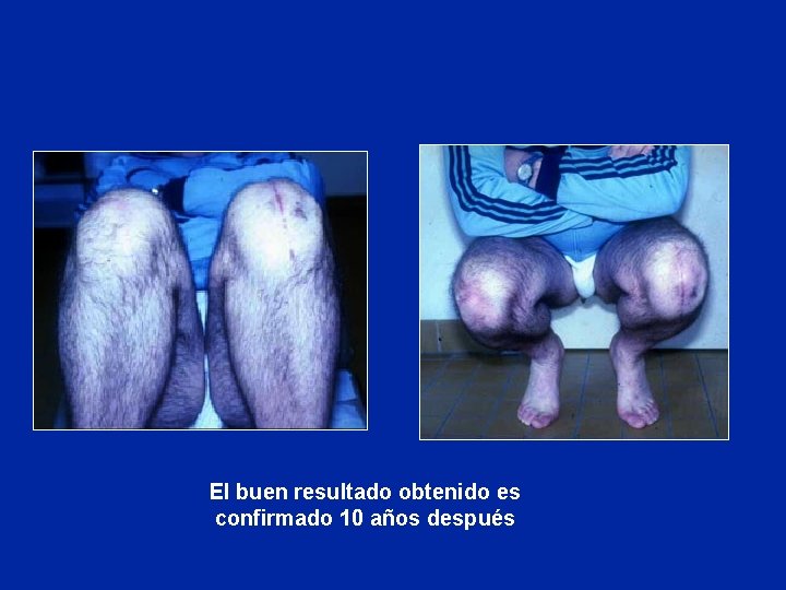 El buen resultado obtenido es confirmado 10 años después El buen resultado obtenido es confirmado 10 años después