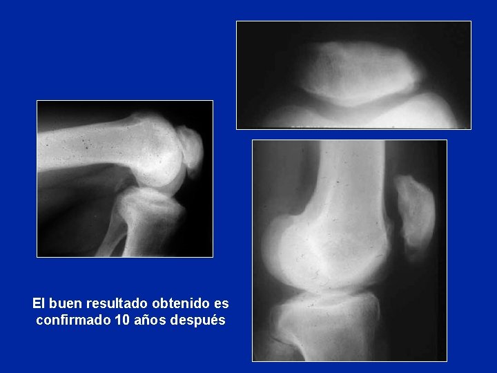 El buen resultado obtenido es confirmado 10 años después El buen resultado obtenido es confirmado 10 años después