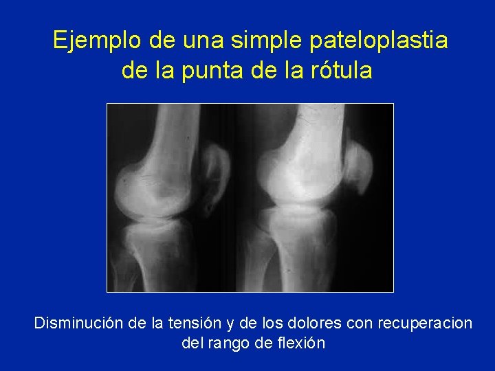 Ejemplo de una simple pateloplastia de la punta de la rótula Disminución de la Ejemplo de una simple pateloplastia de la punta de la rótula Disminución de la
