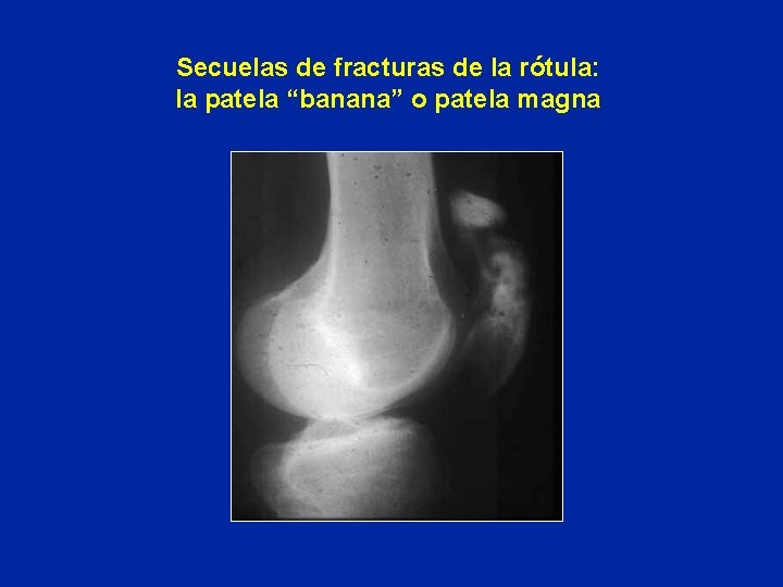 Secuelas de fracturas de la rótula: la patela “banana” o patela magna Secuelas de fracturas de la rótula: la patela “banana” o patela magna