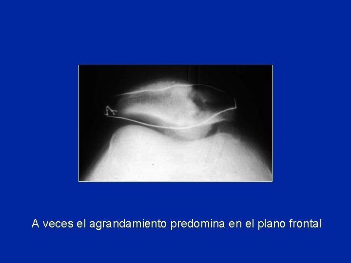 A veces el agrandamiento predomina en el plano frontal A veces el agrandamiento predomina en el plano frontal