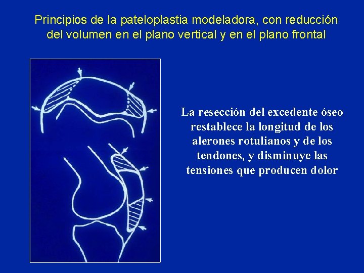 Principios de la pateloplastia modeladora, con reducción del volumen en el plano vertical y Principios de la pateloplastia modeladora, con reducción del volumen en el plano vertical y