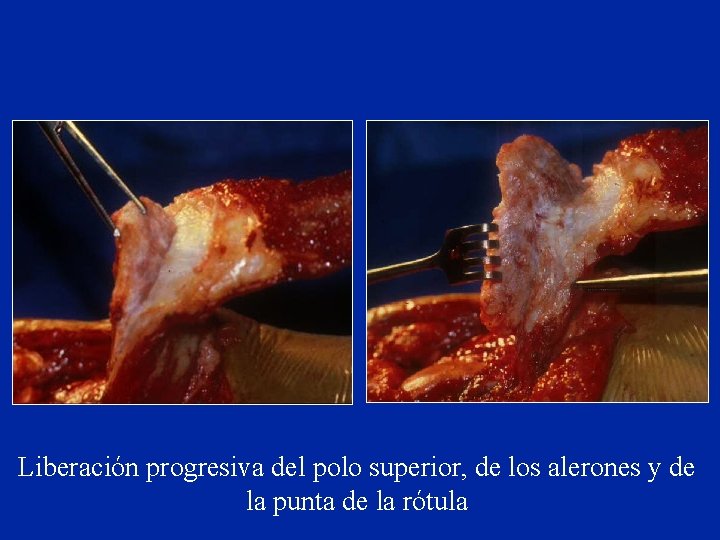 Liberación progresiva del polo superior, de los alerones y de la punta de la Liberación progresiva del polo superior, de los alerones y de la punta de la