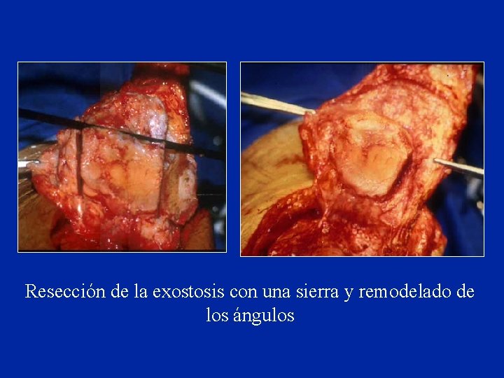 Resección de la exostosis con una sierra y remodelado de los ángulos Resección de la exostosis con una sierra y remodelado de los ángulos