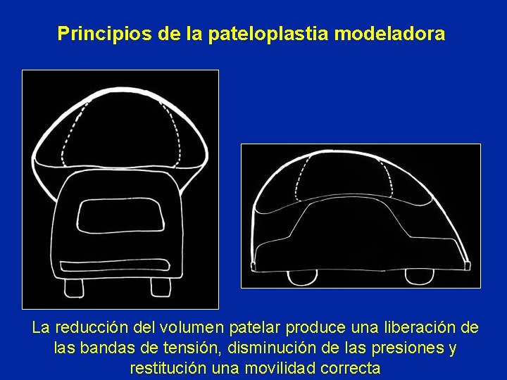 Principios de la pateloplastia modeladora La reducción del volumen patelar produce una liberación de Principios de la pateloplastia modeladora La reducción del volumen patelar produce una liberación de