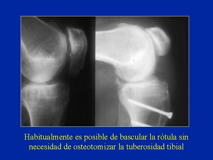 Habitualmente es posible de bascular la rótula sin necesidad de osteotomizar la tuberosidad tibial Habitualmente es posible de bascular la rótula sin necesidad de osteotomizar la tuberosidad tibial