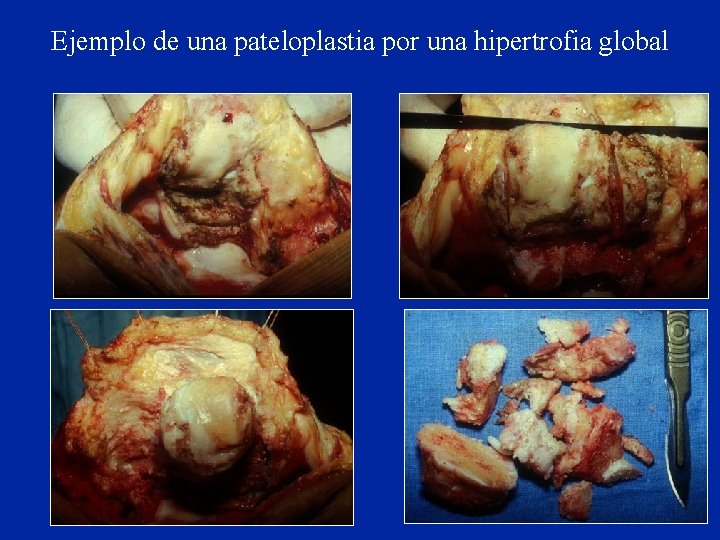 Technique réduction patellaire libérant lesglobal Ejemplo de unadepateloplastia por unaenhipertrofia ailerons et le tendon Technique réduction patellaire libérant lesglobal Ejemplo de unadepateloplastia por unaenhipertrofia ailerons et le tendon