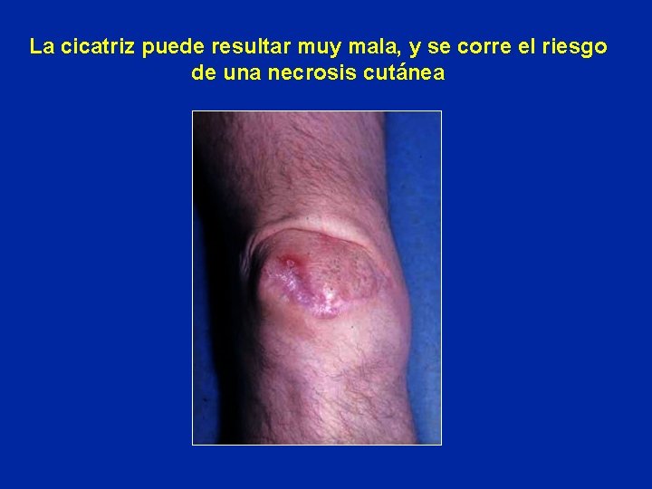 La cicatriz puede resultar muy mala, y se corre el riesgo de una necrosis La cicatriz puede resultar muy mala, y se corre el riesgo de una necrosis