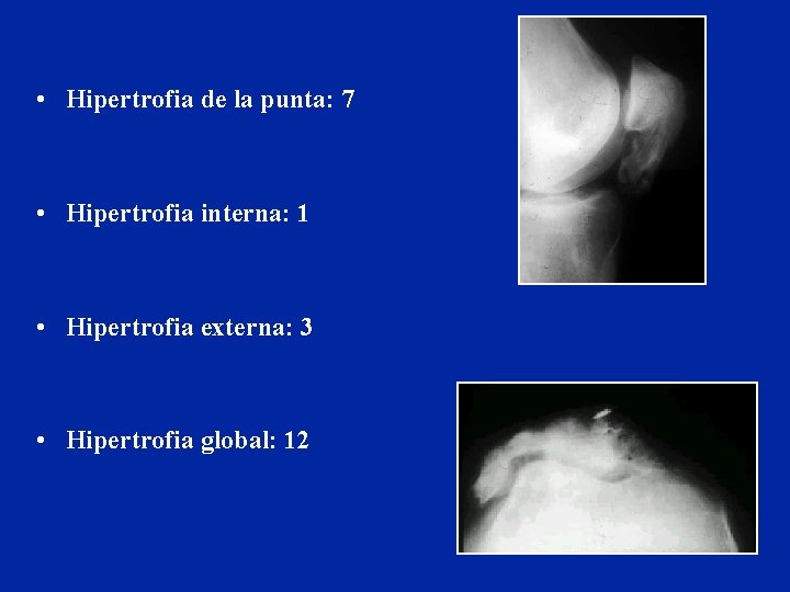 • Hipertrofia de la punta: 7 • Hipertrofia interna: 1 • Hipertrofia externa: • Hipertrofia de la punta: 7 • Hipertrofia interna: 1 • Hipertrofia externa: