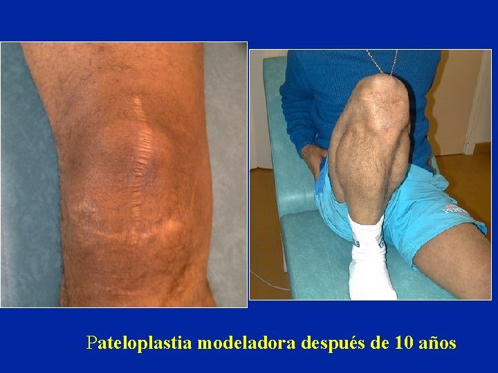 Pateloplastia modeladora después de 10 años Pateloplastia modeladora después de 10 años