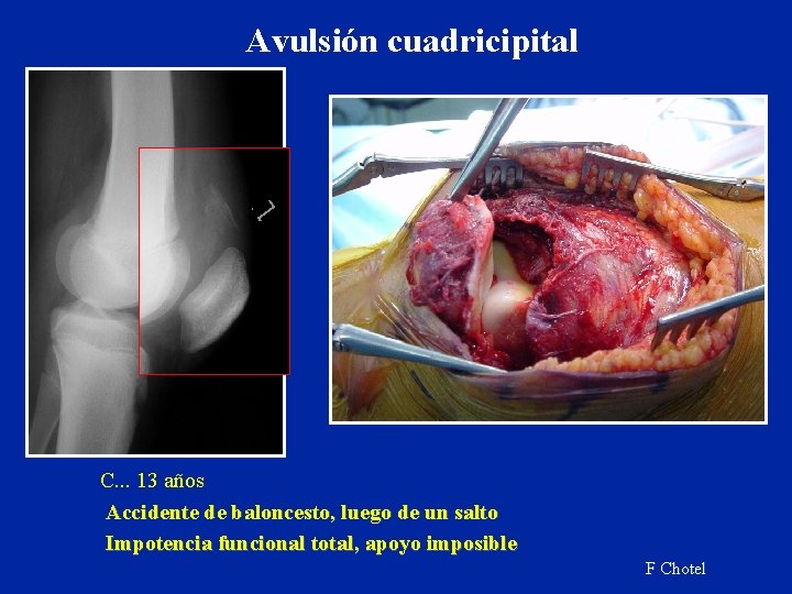 Avulsión cuadricipital C. . . 13 años Accidente de baloncesto, luego de un salto Avulsión cuadricipital C. . . 13 años Accidente de baloncesto, luego de un salto