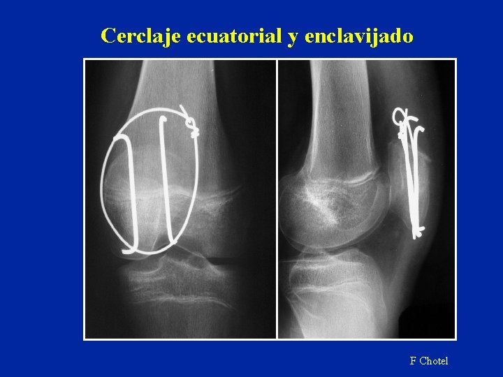 Cerclaje ecuatorial y enclavijado F Chotel Cerclaje ecuatorial y enclavijado F Chotel