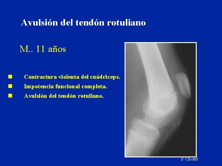 Avulsión del tendón rotuliano M. . 11 años n n Contractura violenta del cuádriceps. Avulsión del tendón rotuliano M. . 11 años n n Contractura violenta del cuádriceps.