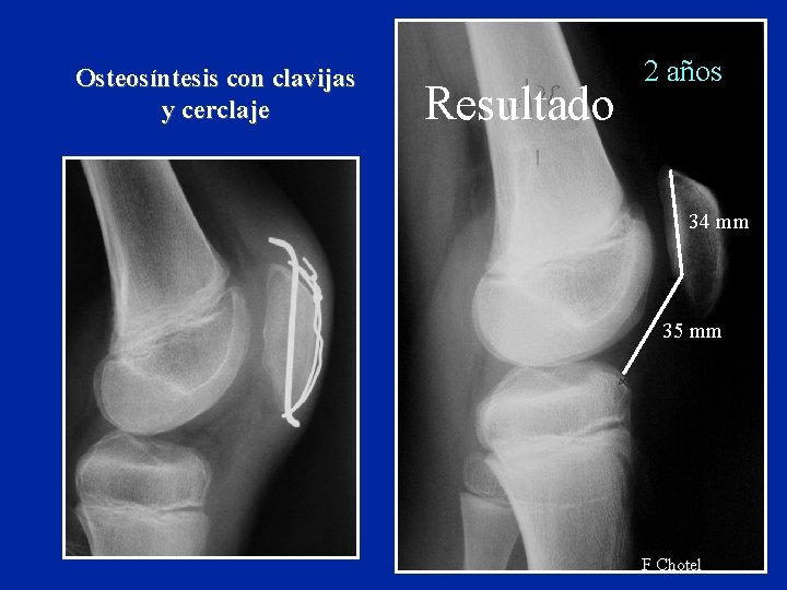 Osteosíntesis con clavijas y cerclaje Resultado 2 años 34 mm 35 mm F Chotel Osteosíntesis con clavijas y cerclaje Resultado 2 años 34 mm 35 mm F Chotel