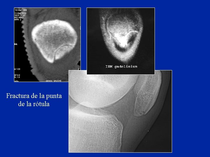 Fractura de la punta de la rótula Fractura de la punta de la rótula