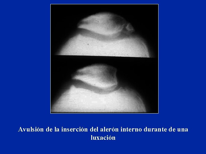 Avulsión de la inserción del alerón interno durante de una luxación Avulsión de la inserción del alerón interno durante de una luxación