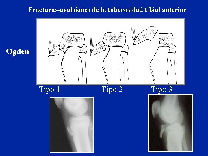 Fracturas-avulsiones de la tuberosidad tibial anterior Ogden Tipo 1 Tipo 2 Tipo 3 Fracturas-avulsiones de la tuberosidad tibial anterior Ogden Tipo 1 Tipo 2 Tipo 3