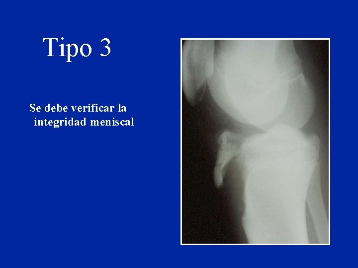 Tipo 3 Se debe verificar la integridad meniscal Tipo 3 Se debe verificar la integridad meniscal