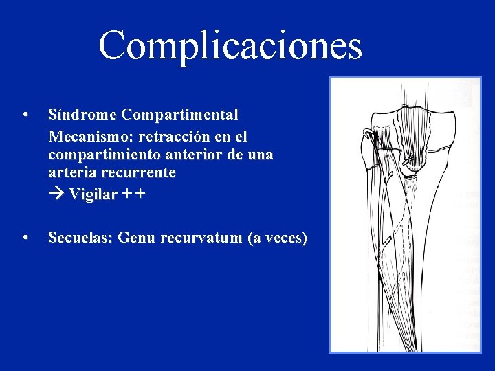 Complicaciones • Síndrome Compartimental Mecanismo: retracción en el compartimiento anterior de una arteria recurrente Complicaciones • Síndrome Compartimental Mecanismo: retracción en el compartimiento anterior de una arteria recurrente