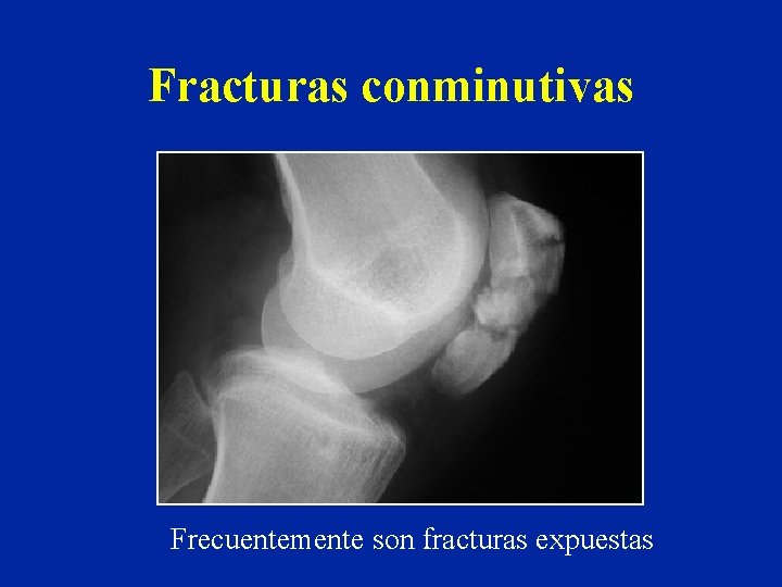 Fracturas conminutivas Frecuentemente son fracturas expuestas Fracturas conminutivas Frecuentemente son fracturas expuestas