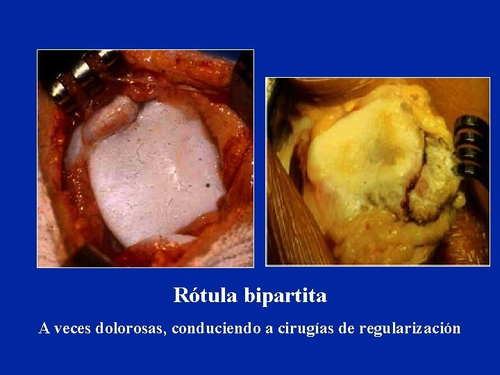 Rótula bipartita A veces dolorosas, conduciendo a cirugías de regularización Rótula bipartita A veces dolorosas, conduciendo a cirugías de regularización