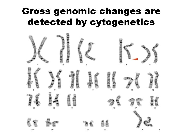 Gross genomic changes are detected by cytogenetics 