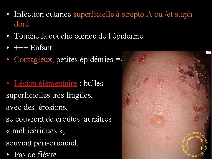  • Infection cutanée superficielle à strepto A ou /et staph doré • Touche