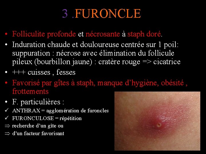 3. FURONCLE • Folliculite profonde et nécrosante à staph doré. • Induration chaude et