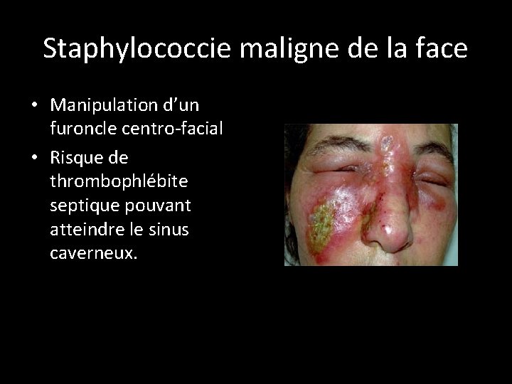 Staphylococcie maligne de la face • Manipulation d’un furoncle centro-facial • Risque de thrombophlébite
