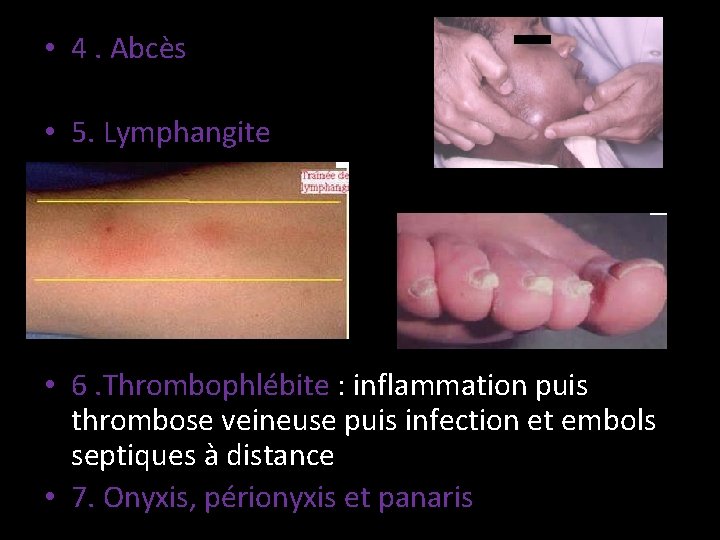  • 4. Abcès • 5. Lymphangite • 6. Thrombophlébite : inflammation puis thrombose