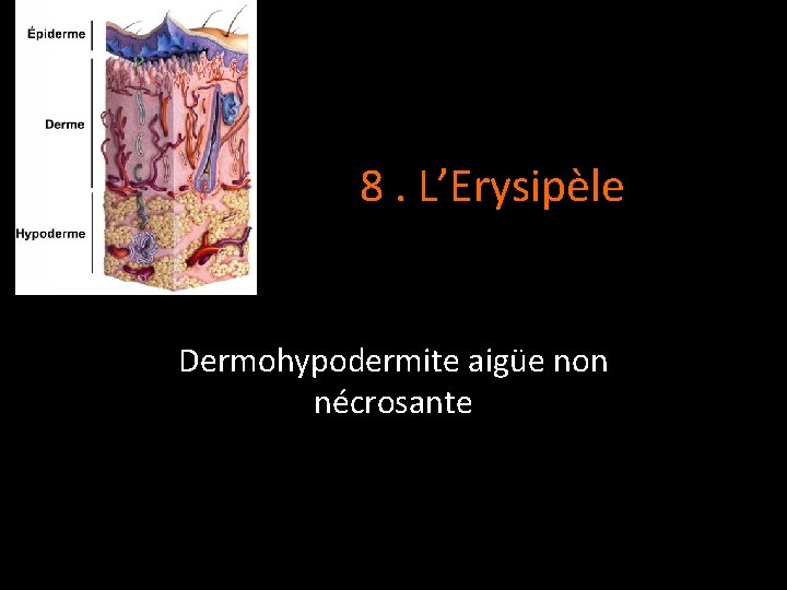 8. L’Erysipèle Dermohypodermite aigüe non nécrosante 