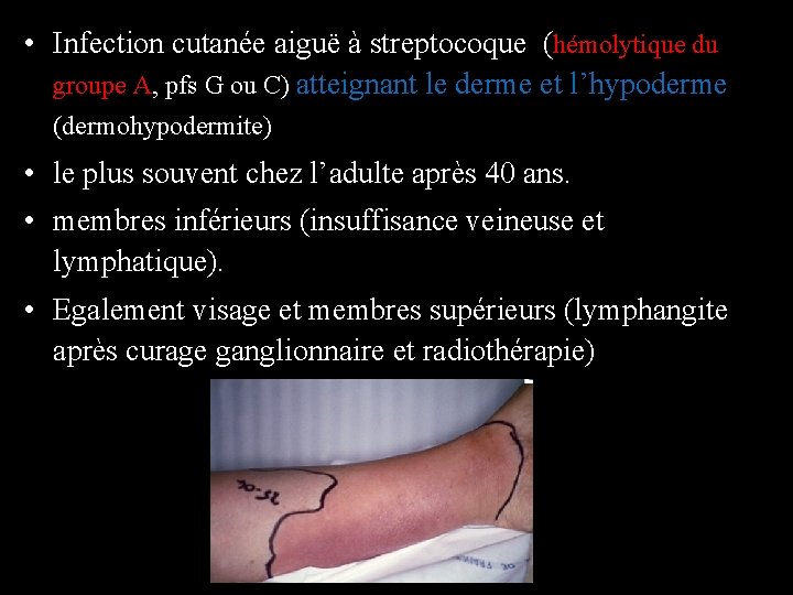  • Infection cutanée aiguë à streptocoque (hémolytique du groupe A, pfs G ou