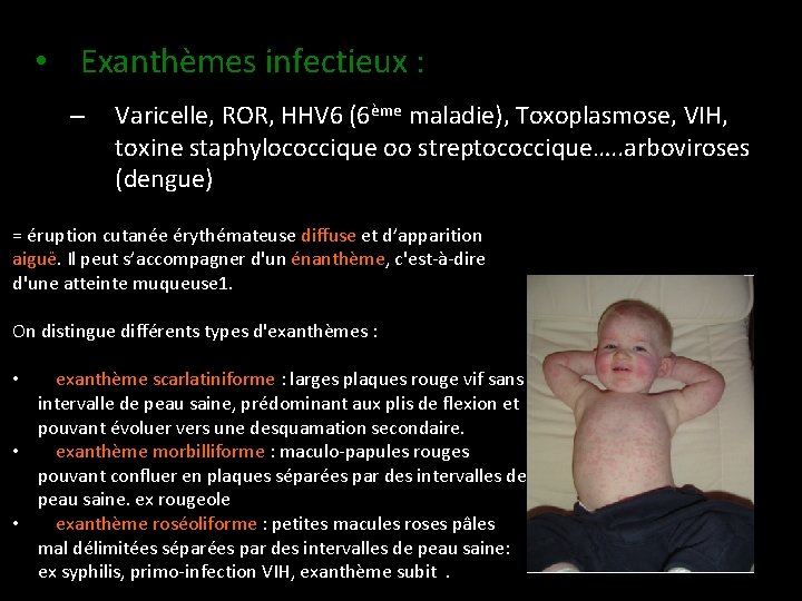  • Exanthèmes infectieux : – Varicelle, ROR, HHV 6 (6ème maladie), Toxoplasmose, VIH,