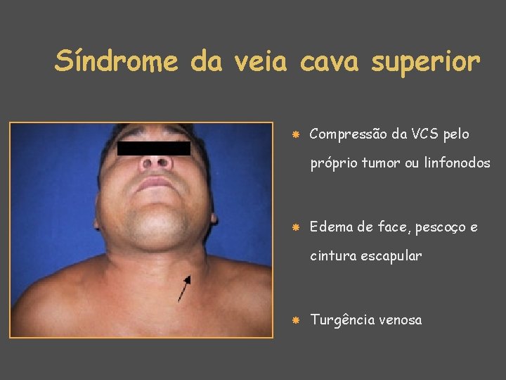 Síndrome da veia cava superior Compressão da VCS pelo próprio tumor ou linfonodos Edema