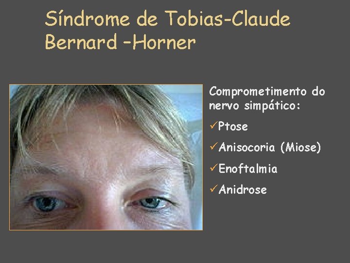 Síndrome de Tobias-Claude Bernard –Horner Comprometimento do nervo simpático: üPtose üAnisocoria (Miose) üEnoftalmia üAnidrose