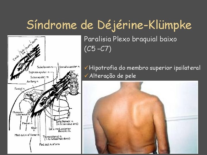 Síndrome de Déjérine-Klümpke Paralisia Plexo braquial baixo (C 5 –C 7) üHipotrofia do membro