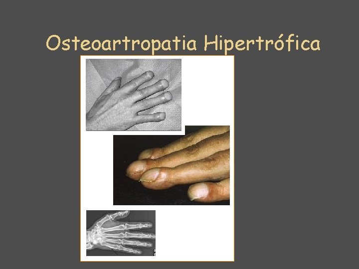 Osteoartropatia Hipertrófica 