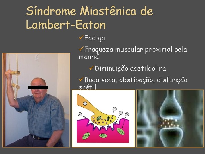 Síndrome Miastênica de Lambert-Eaton üFadiga üFraqueza muscular proximal pela manhã üDiminuição acetilcolina üBoca seca,