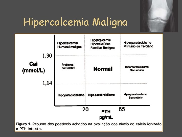Hipercalcemia Maligna 