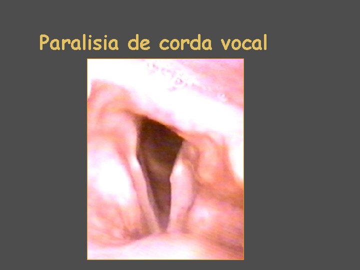 Paralisia de corda vocal 