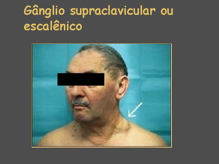 Gânglio supraclavicular ou escalênico 