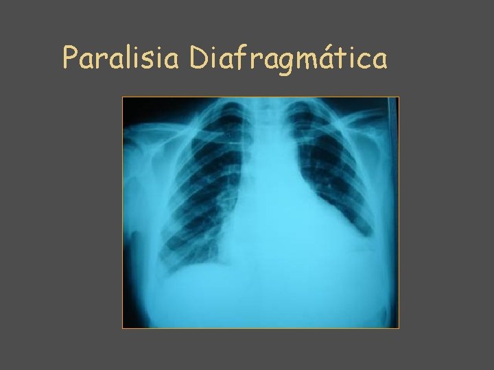 Paralisia Diafragmática 