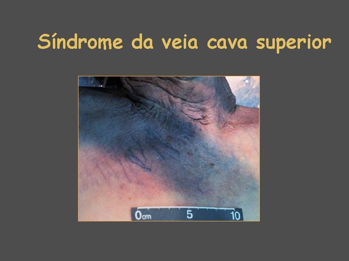 Síndrome da veia cava superior 