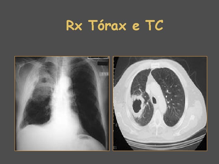 Rx Tórax e TC 